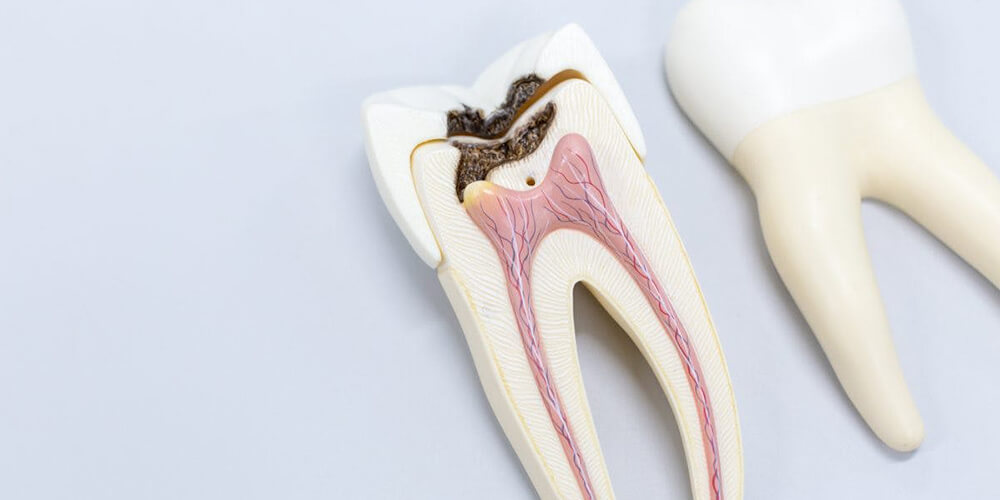 Painless Root Canal Treatment in Sayan